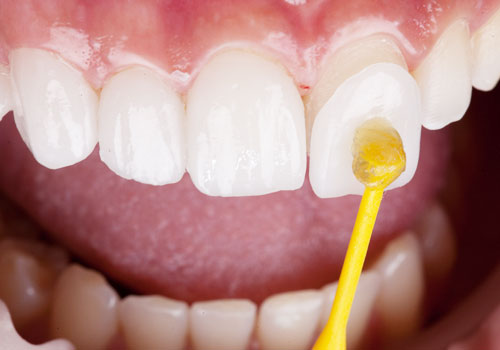 Ceramic veneers 