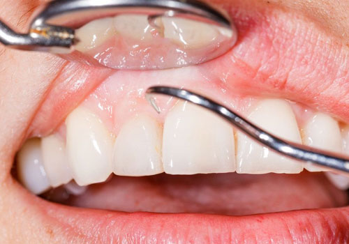 Gum Contouring 