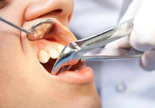 Tooth Extraction 